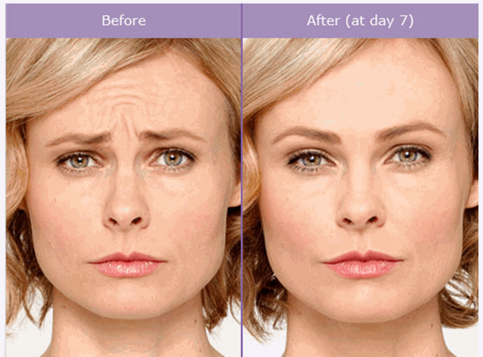 meirson-botox-before-and-after