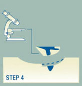 mohs-surgery-step-4