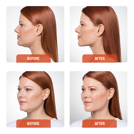 meirson-kybella-before-&-after